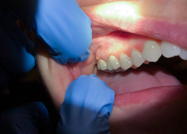 Best Emergency Wisdom Tooth Extraction in Atchison, KS