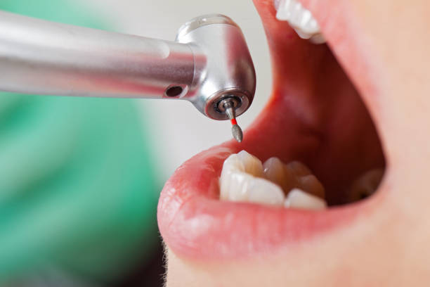 Best Emergency Wisdom Tooth Extraction in Atchison, KS